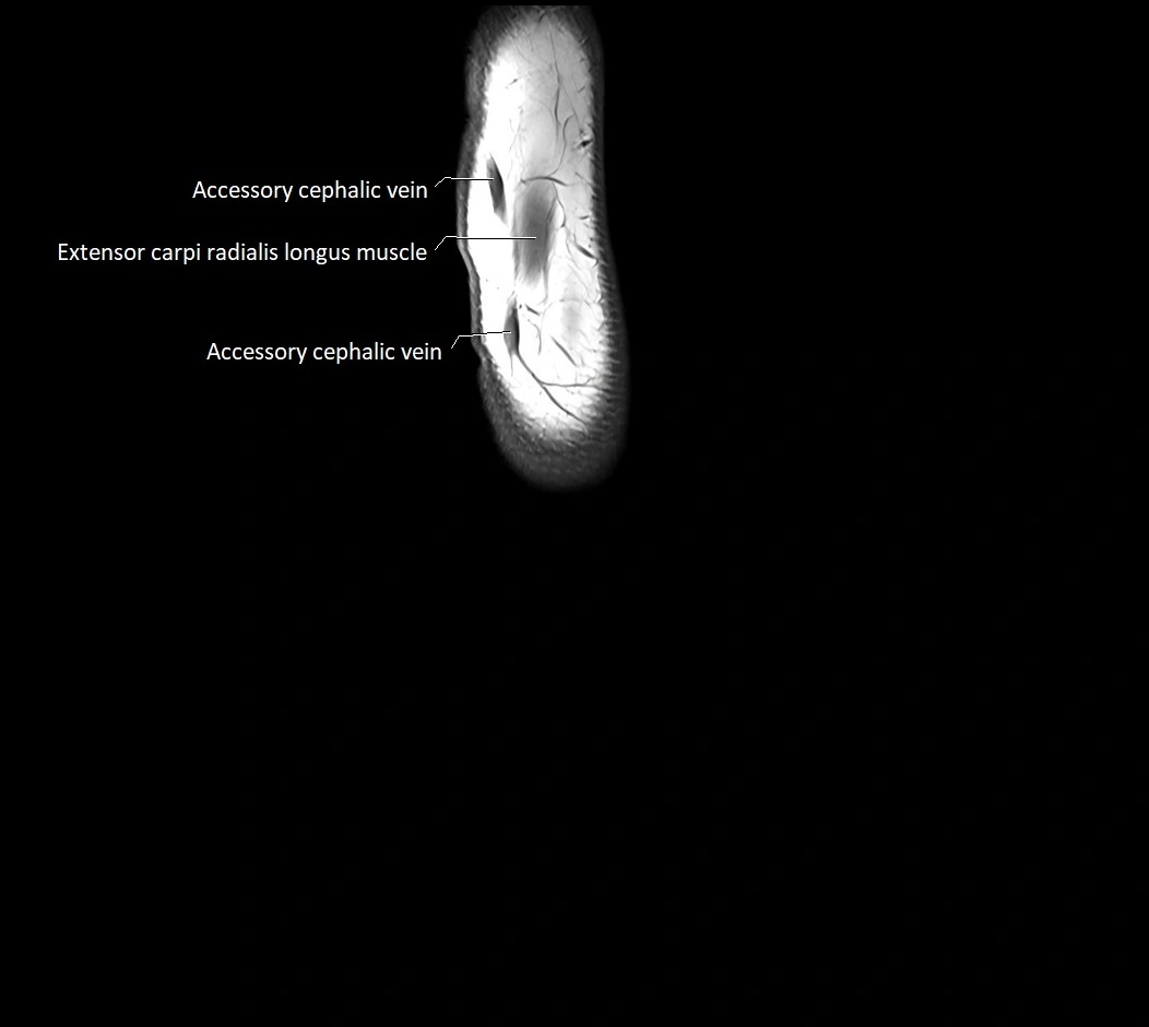 MRI 3T forearm sagittal labelled cross sectional anatomy image 2.webp